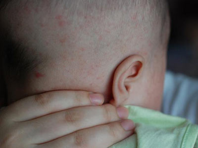 婴儿湿疹是因为那些原因引起的