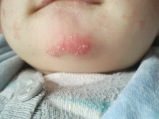 婴儿湿疹危害