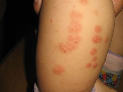 患上丘疹性荨麻疹危害很大吗
